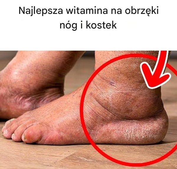 Najlepsza witamina na obrzęki nóg i kostek
