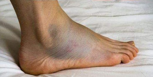 Jakie są objawy zawału serca u kobiet?