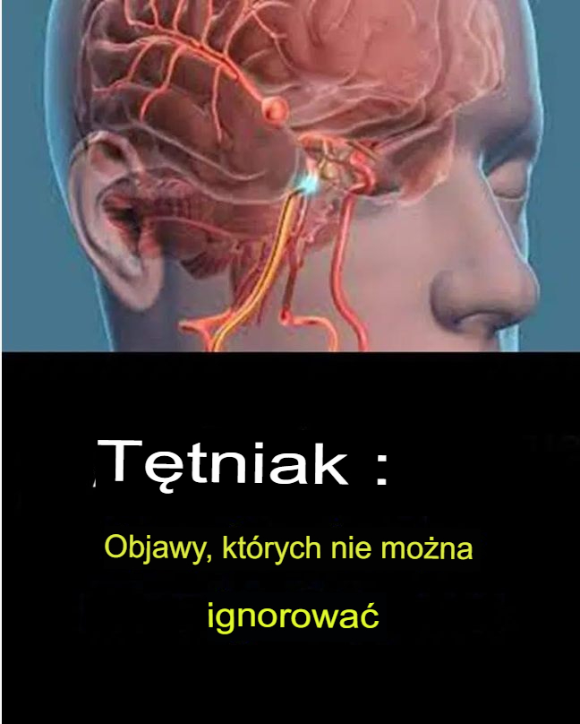 Tętniak mózgu – objawy, których nie wolno ignorować