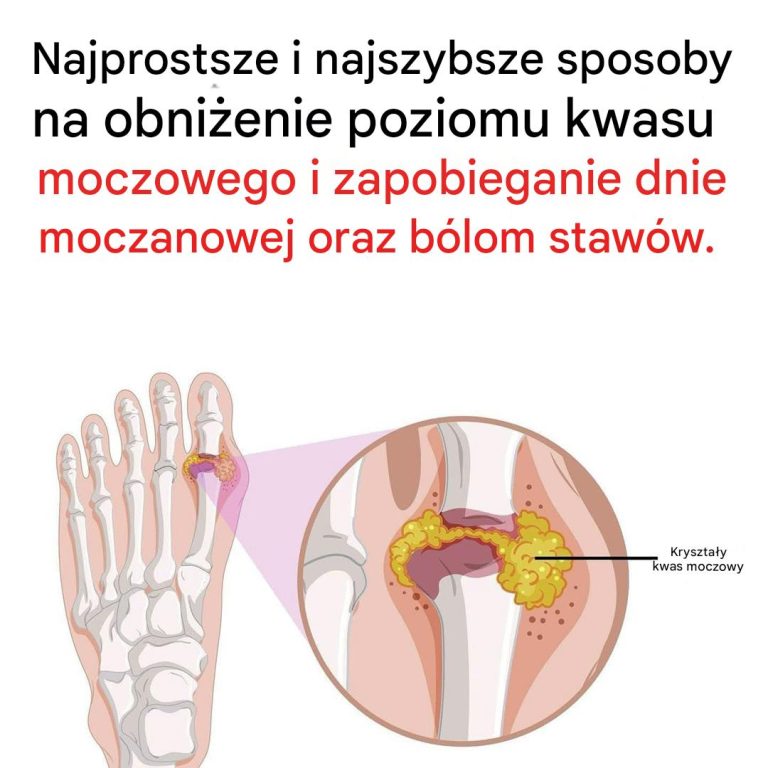 Jak złagodzić ból stawów spowodowany dną moczanową?