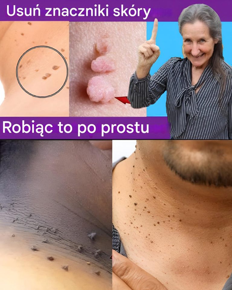 Brodawki podeszwowe i narośla skórne znikną w ciągu jednego dnia dzięki temu przepisowi