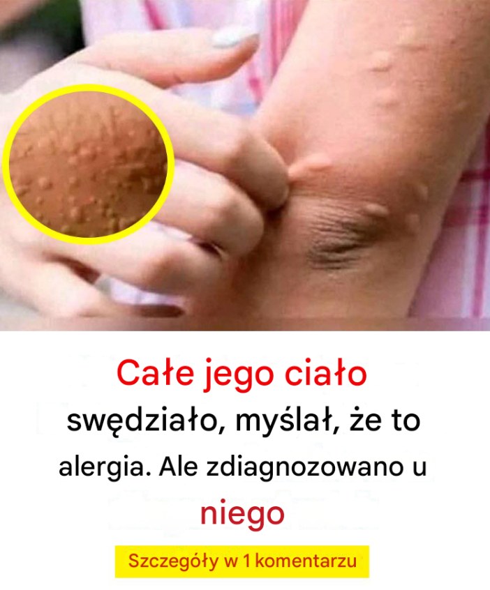 Całe jego ciało swędziało, pomyślał, że to alergia i zdiagnozowano to