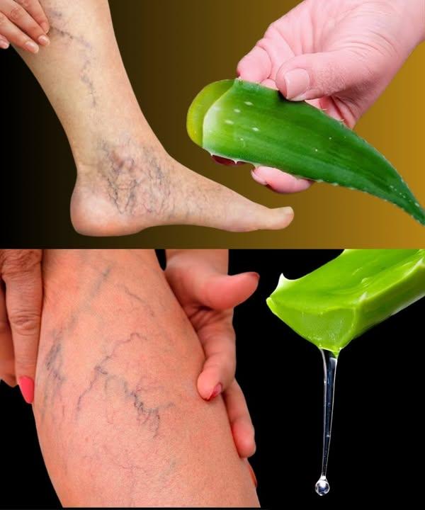 Jak pozbyć się żylaków i złagodzić uczucie ciężkich nóg za pomocą aloesu