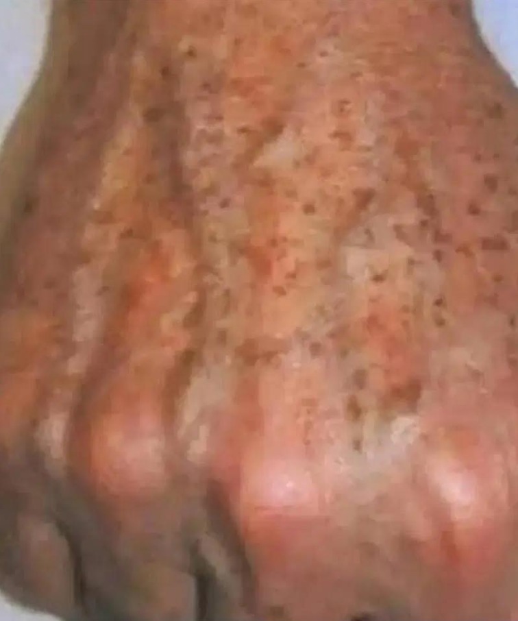 Czy wiesz, że jeśli na dłoniach pojawiają się PLAMY, jest to znak, że cierpisz na