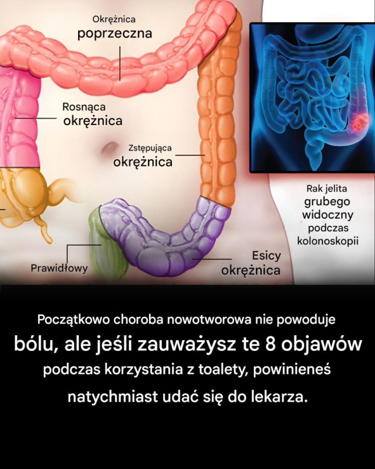 7 ostrzegawczych objawów raka jelita grubego, których nigdy nie należy ignorować