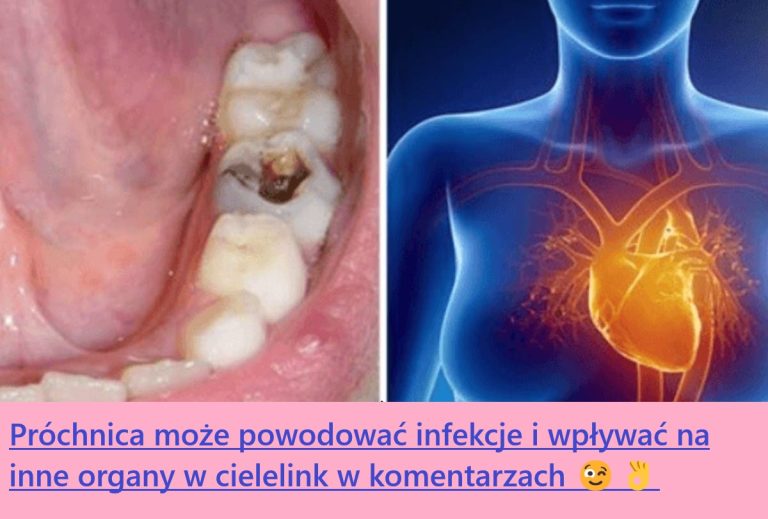 Próchnica może powodować infekcje i wpływać na inne organy w ciele