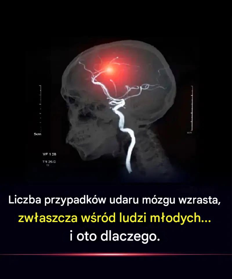 Przypadki udaru mózgu są coraz częstsze, zwłaszcza wśród ludzi młodych… i oto dlaczego.