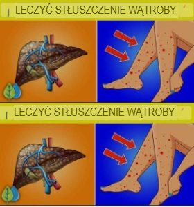 7 oznak i objawów stłuszczenia wątroby i jak leczyć je naturalnie