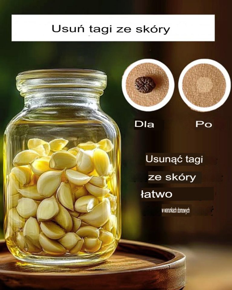 3 domowe sposoby na pozbycie się narośli skórnych