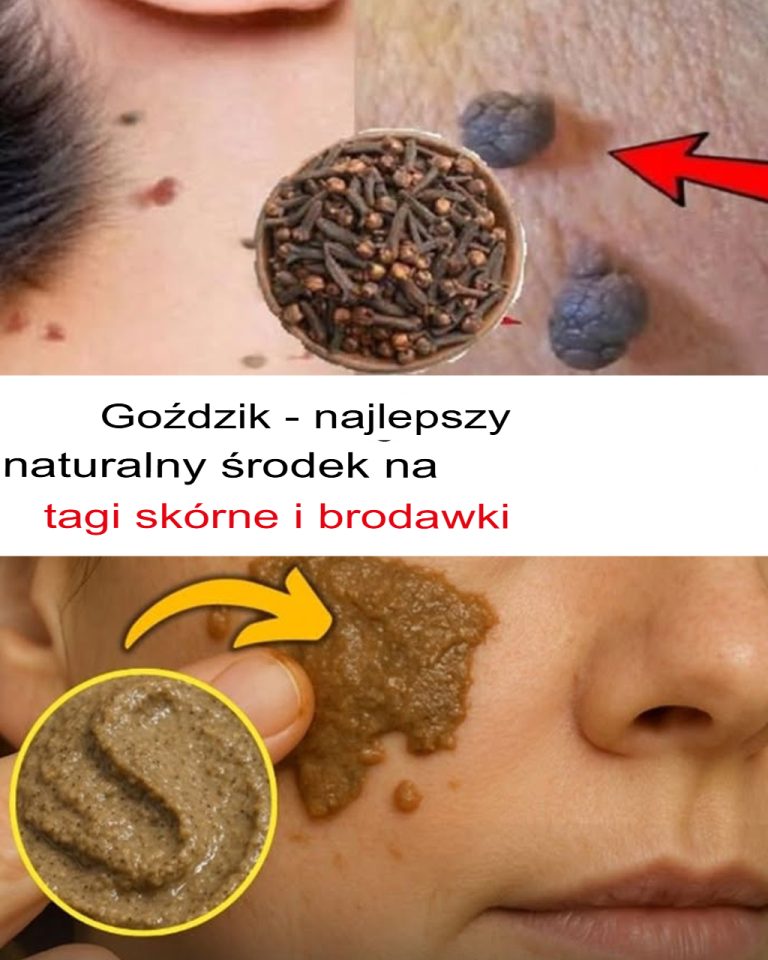 Goździki usuwają narośla skórne i brodawki: Jak je stosować?