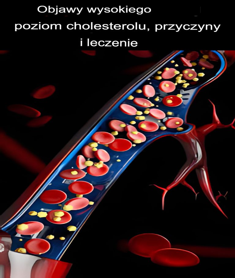Wysoki poziom cholesterolu - objawy, przyczyny i leczenie