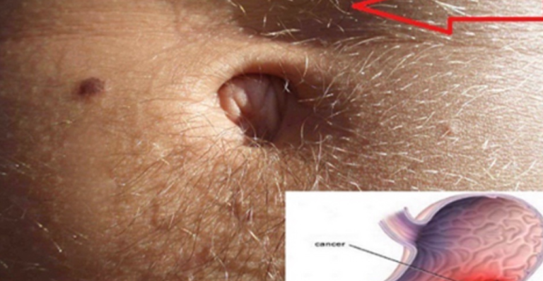 Rak żołądka rozwija się powoli. Oto pierwsze objawy!