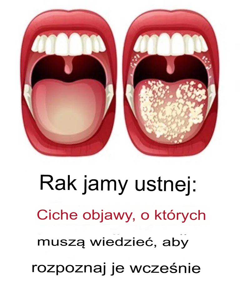 Rak jamy ustnej: objawy, których nie należy ignorować.