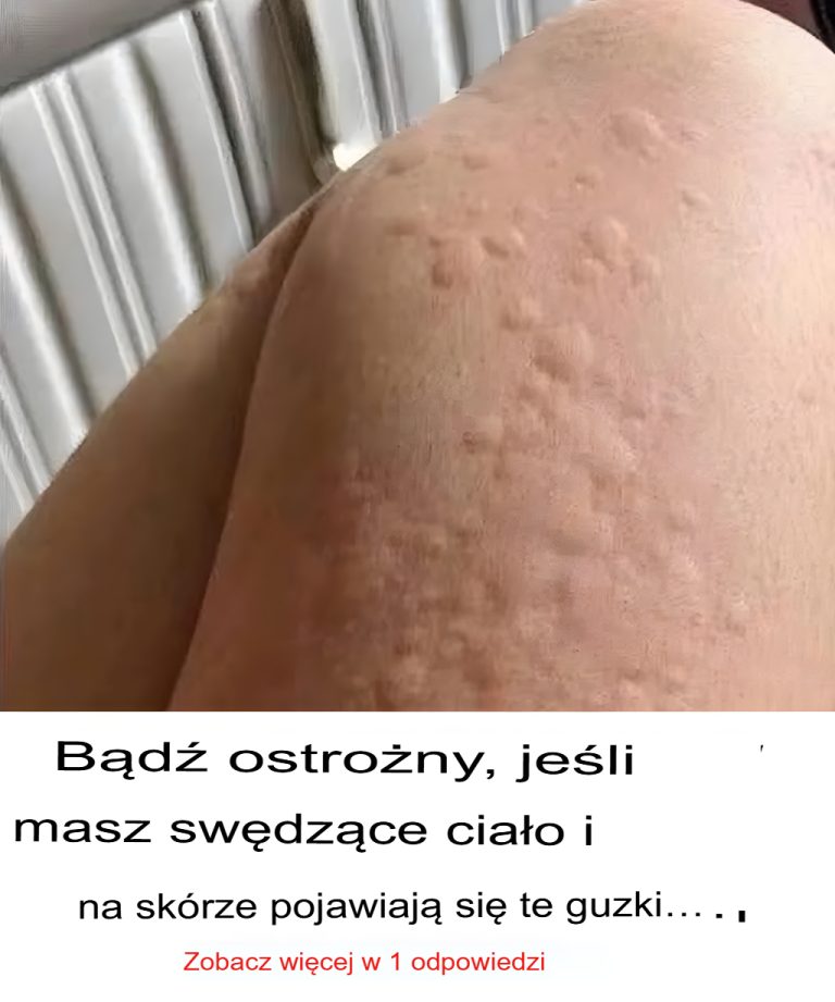Dlaczego pokrzywka pojawia się na skórze? Oto zaskakujące czynniki, o których możesz nie wiedzieć.