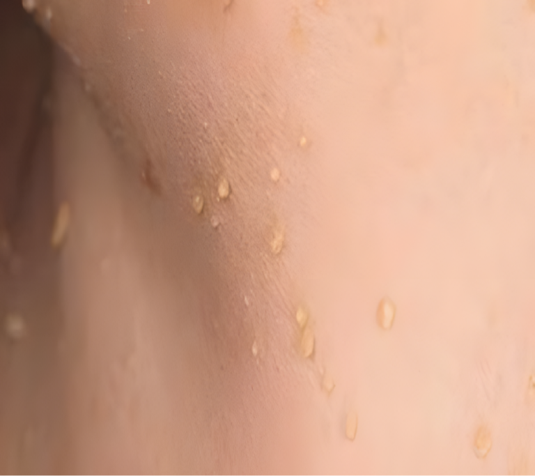 Jak pozbyć się małych brodawek skórnych przy pomocy naturalnego produktu?