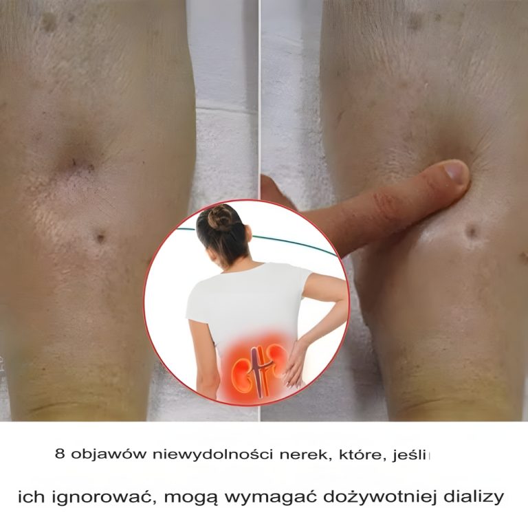 Ból nerek: Jakie są objawy bólu nerek i kiedy należy się martwić?