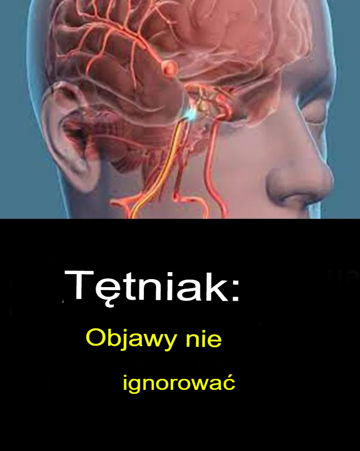 Tętniak: Objawy, których nie należy ignorować