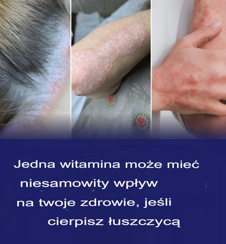 Jedna witamina może mieć niesamowity wpływ na Twoje zdrowie, jeśli cierpisz na łuszczycę