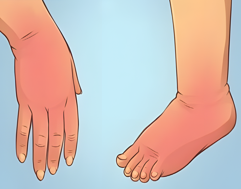 Czy cierpisz na obrzęk rąk lub stóp? Przyczyną mogą być nawyki żywieniowe i brak ruchu.