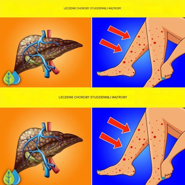 7 oznak i objawów stłuszczenia wątroby i jak leczyć je naturalnie