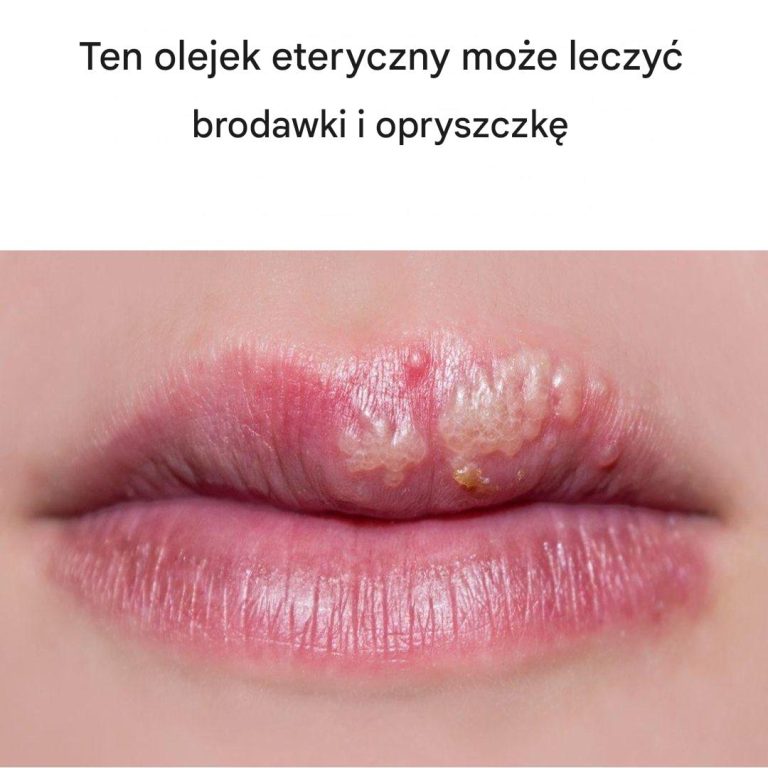 Olejek z drzewa herbacianego na brodawki i opryszczkę