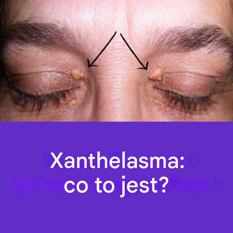 Ksantelazma: Poznaj przyczyny, profilaktykę i leczenie