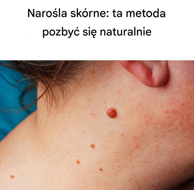 Narośla skórne: jak pozbyć się ich naturalnie