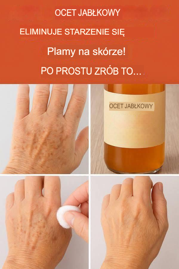 Leczenie plam starczych octem jabłkowym