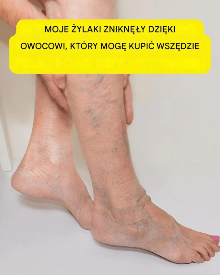 Moje żylaki zniknęły dzięki owocowi, który mogę kupić wszędzie