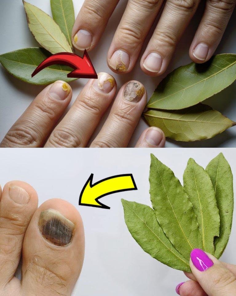 Pozbądź się grzybicy paznokci naturalnie za mniej niż 50 centów: Mało znana moc liści laurowych