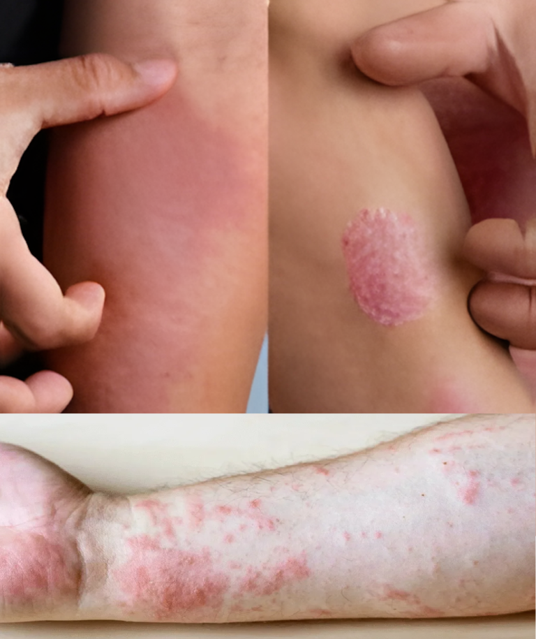 15 ostrzegawczych objawów białaczki, których nigdy nie należy ignorować