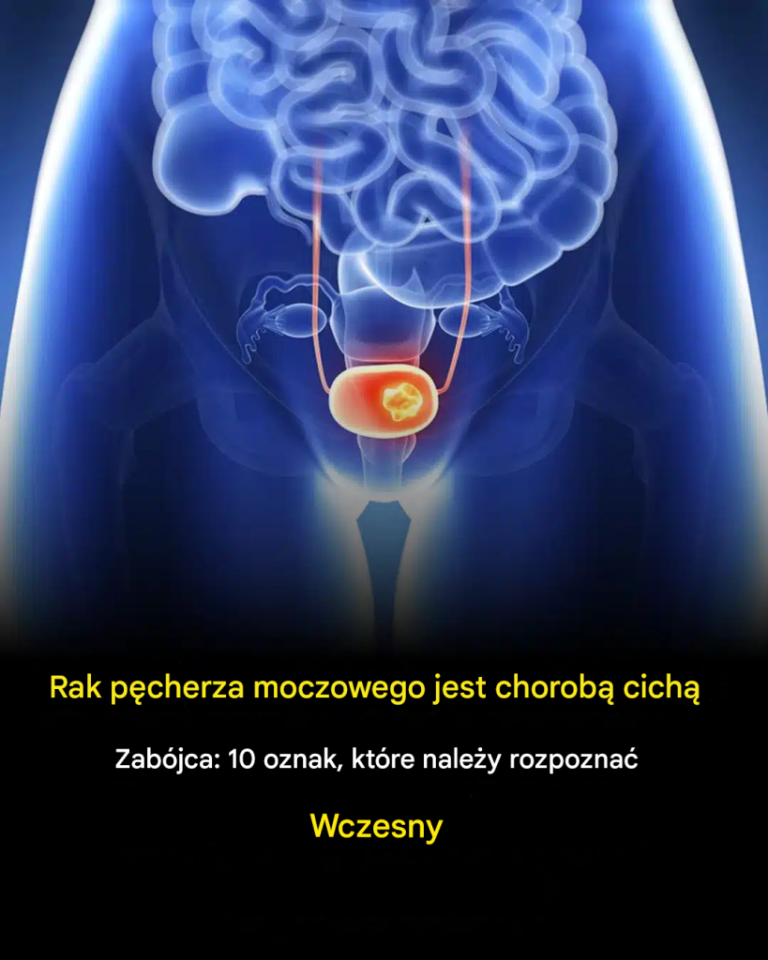 10 objawów raka pęcherza moczowego, na które należy zwrócić uwagę