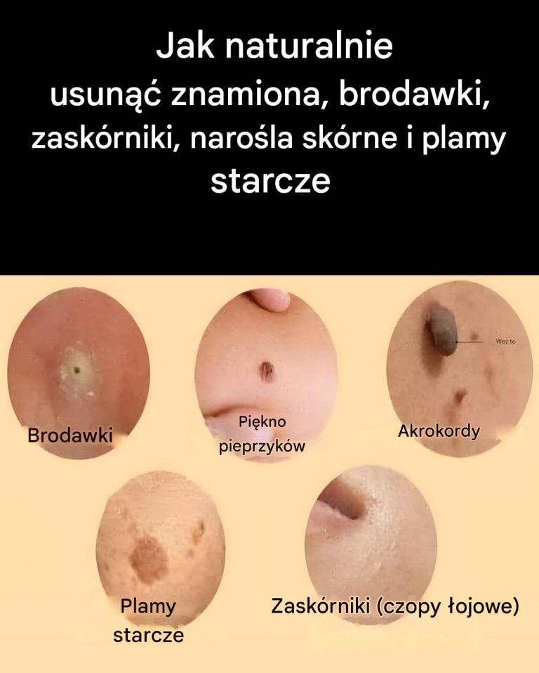 Naturalne środki zaradcze na leczenie narośli skórnych, brodawek i zaskórników
