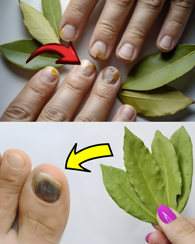 Naturalne usuwanie grzybicy paznokci za mniej niż 50 centów: mało znana moc liści laurowych