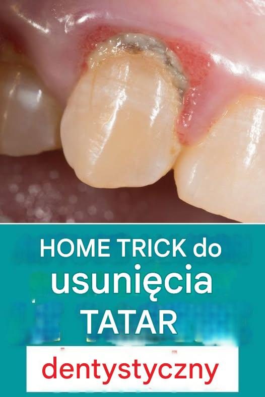 Domowy sposób na samodzielne usuwanie kamienia nazębnego