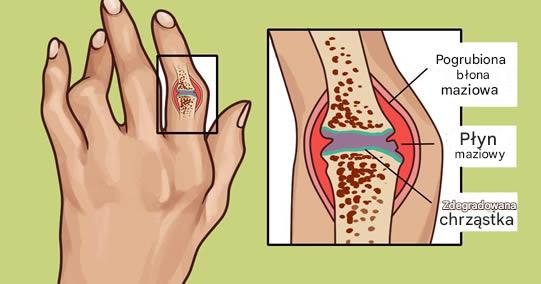 Starożytne indyjskie lekarstwo trwające 3000 lat na leczenie reumatoidalnego zapalenia stawów i stanu zapalnego