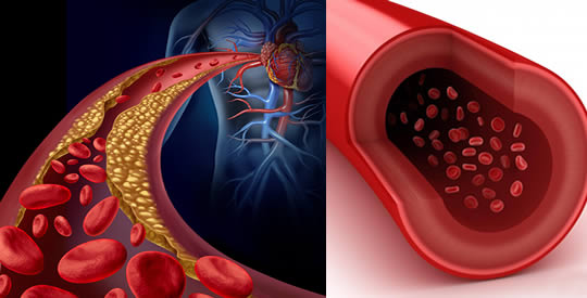 Starożytny niemiecki środek, który odblokowuje tętnice eliminujące tłuszcz i cholesterol