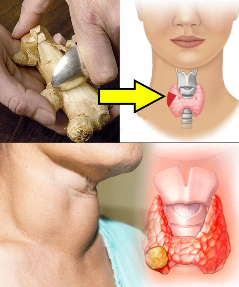 19 produktów spożywczych, których należy unikać, jeśli cierpisz na niedoczynność tarczycy lub problemy z tarczycą