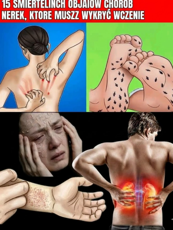 15 śmiertelnych objawów chorób nerek, które musisz wykryć wcześnie