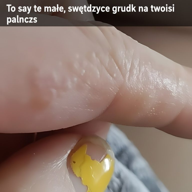 To są te małe, swędzące grudki na twoich palcach